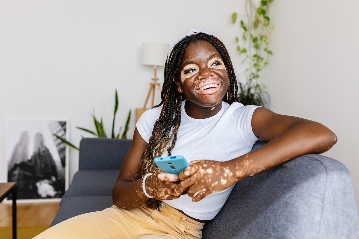 Happy young woman with vitiligo sitting at home.